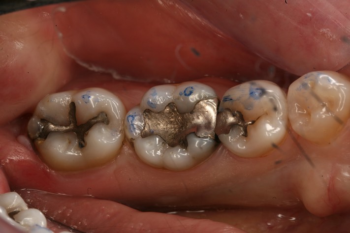 Ted Kanamori #29, 30, 31 pre-op