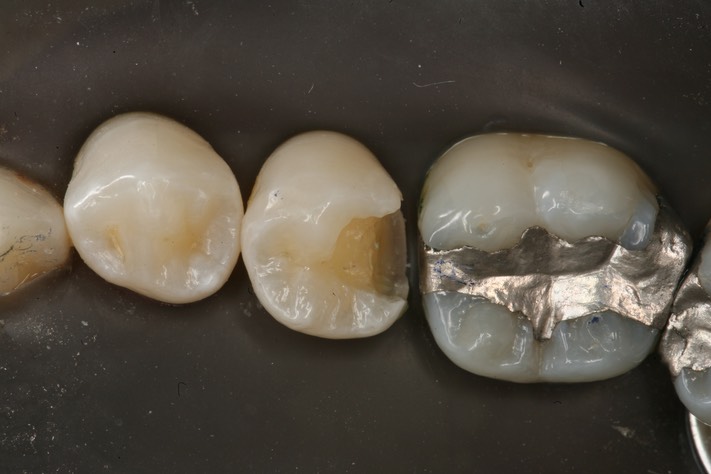 John Wu #20 caries removal