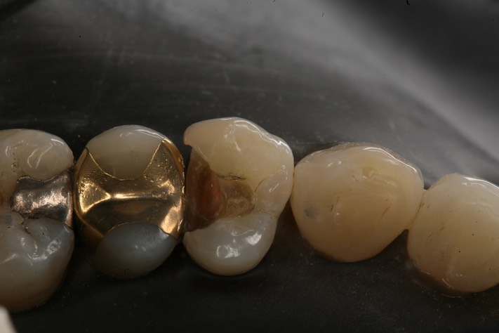 Brandon Yokota #12 caries removal