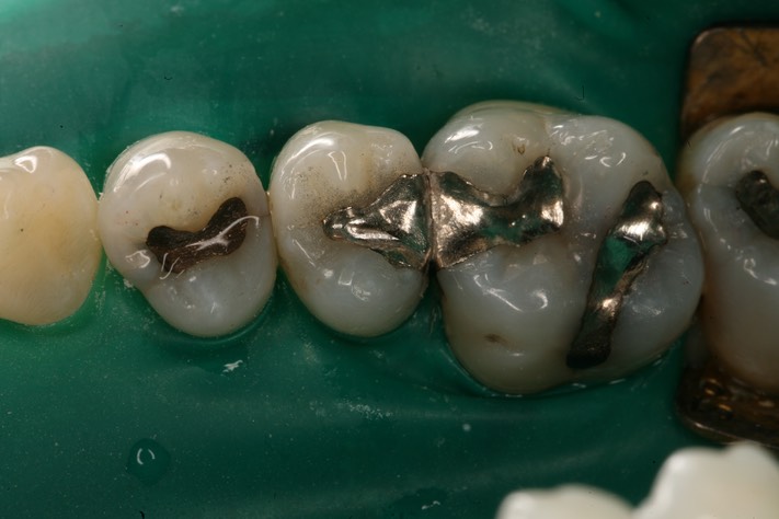 Mitchell Chun #4 pre-op with dam