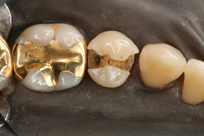 Wayne Chin #29 caries removal