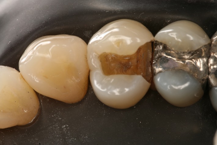 Carla Fukumoto #5 caries removal