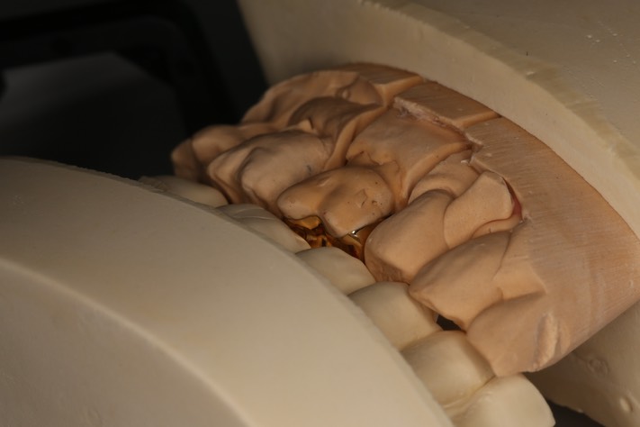 Frank Fukuda #3 casting occluded