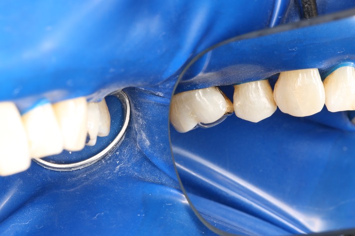 Mark Chun #14 buccal view 2