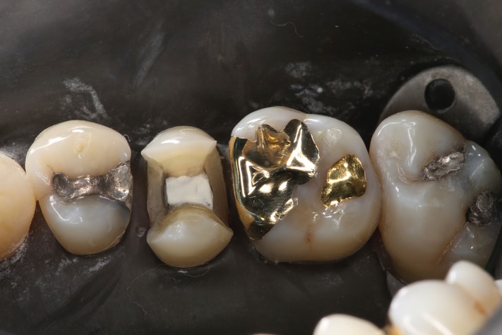 Gary Umeda #3 foil & 4 prep 