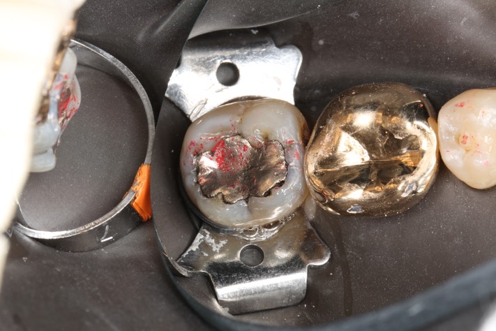 Alan Chinn #31 pre-op