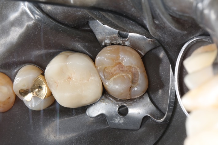 Kyle Chock #2 pre-op