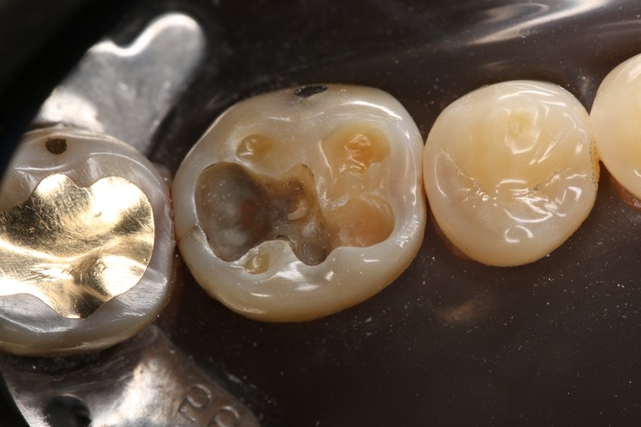 Wes Sato #30 amalgam removal