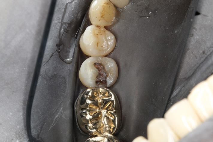 Chris Woo #29 amalgam removal