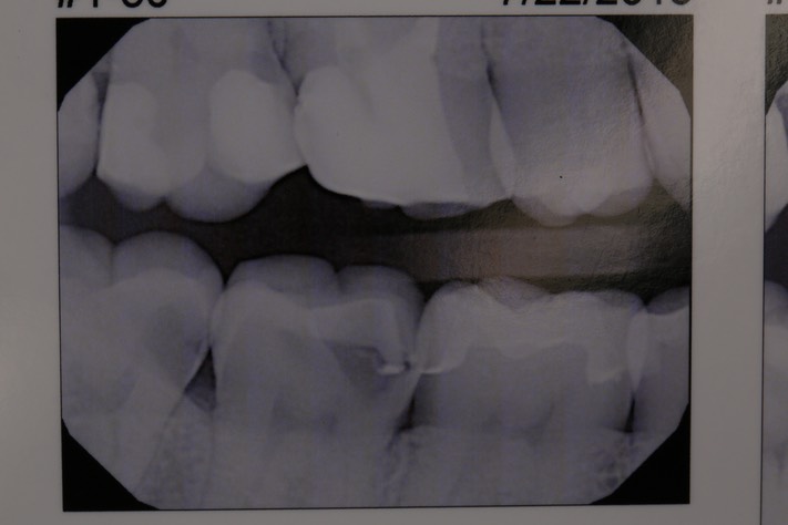 Gary Umeda #2,3 bitewing radiograph