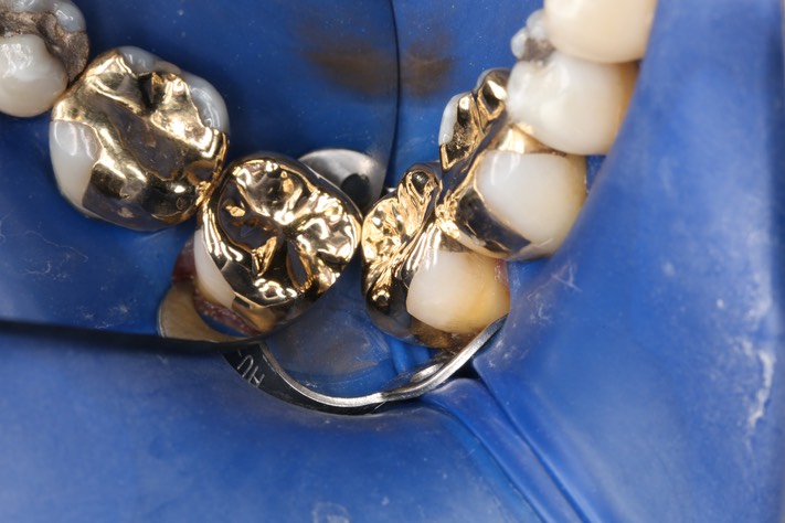 Mark Chun #31  - Occlusal buccal view