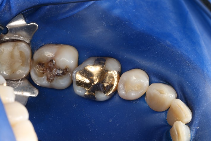 Mark Chun #31 amalgam removal