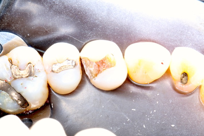 Alan Chinn #12 caries removal