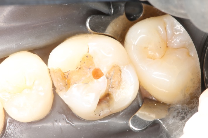 Kyle Chock #3 caries removal