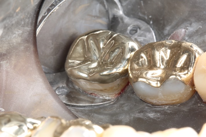 Alan Tamashiro #31 finish - lingual view