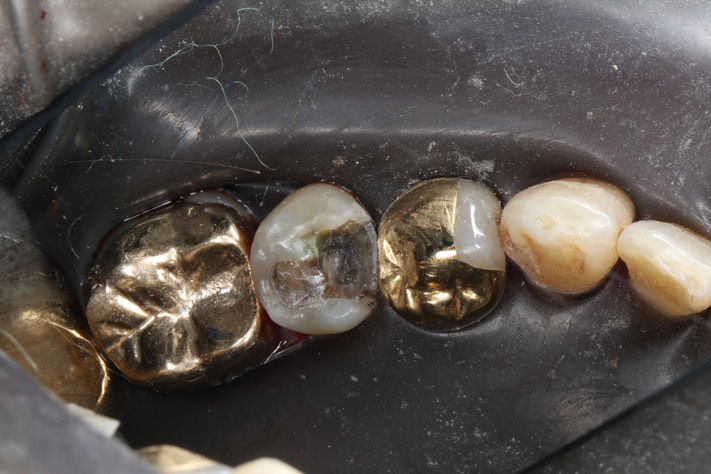 Brian Sato #29 caries removal