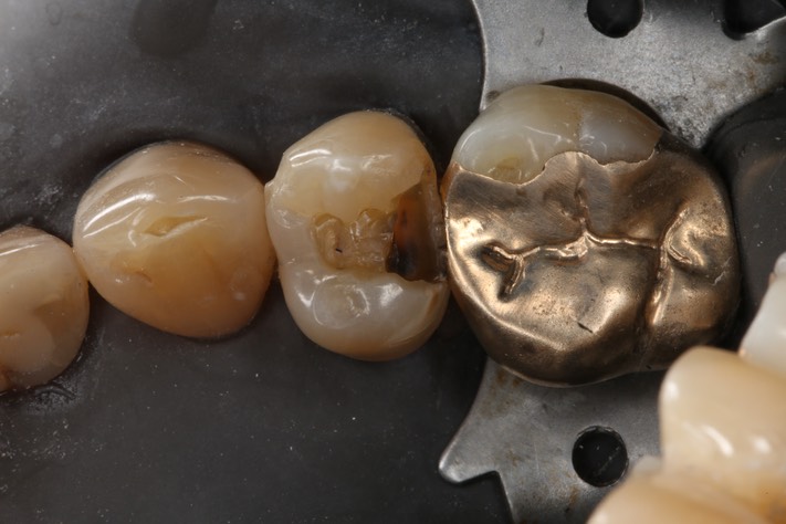 Russ Tabata #4 caries removal