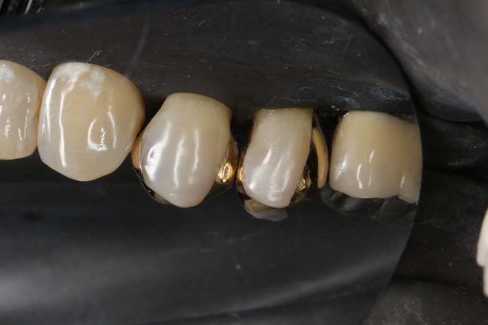 Scott Kanamori #4 buccal view