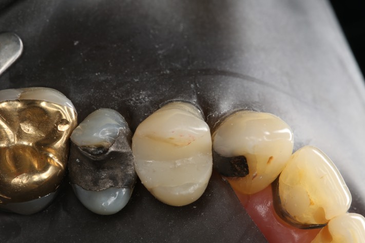 Mendel Sato #13 pre-op