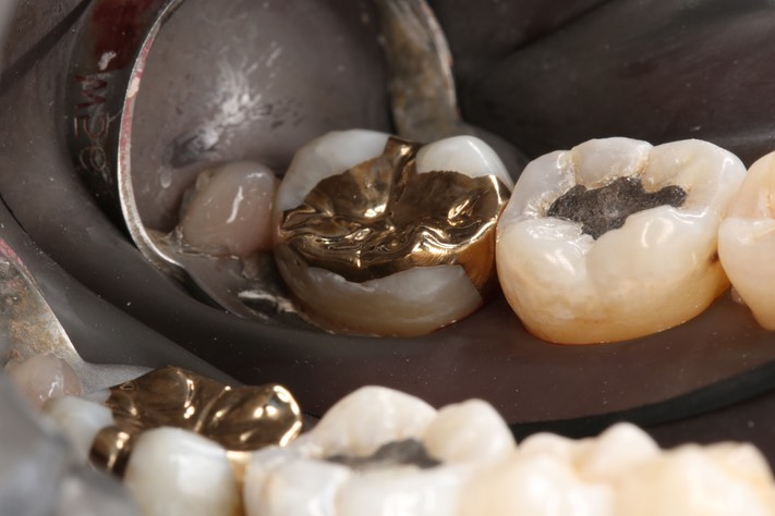 Larry Fujioka #31 finish - lingual view