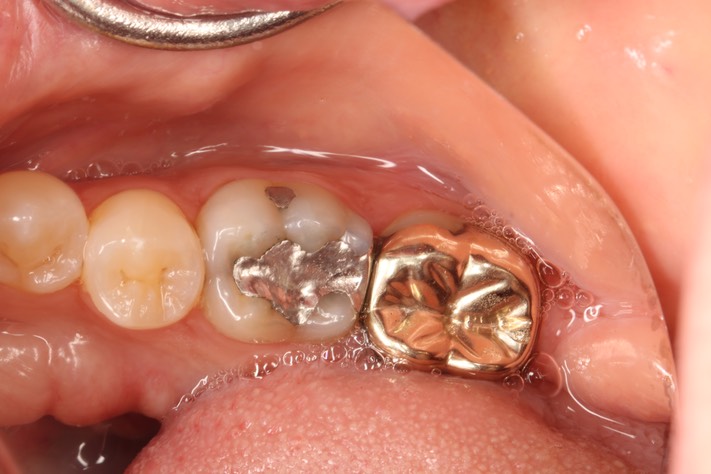 Gary Umeda #30 pre-op