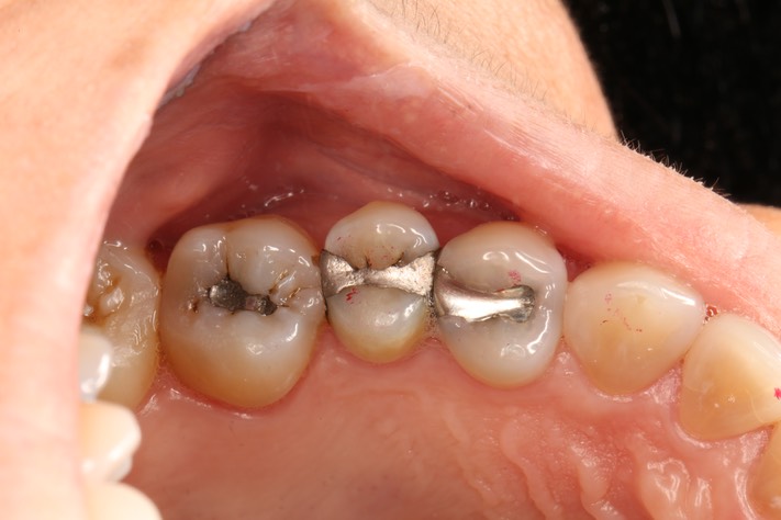 Kyle Chock #12-13 pre-op