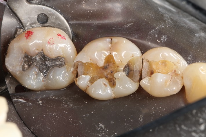 Larry Fujioka #29,30 caries removal