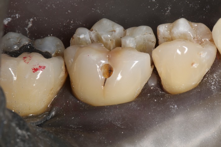 Larry Fujioka #29,30 buccal view