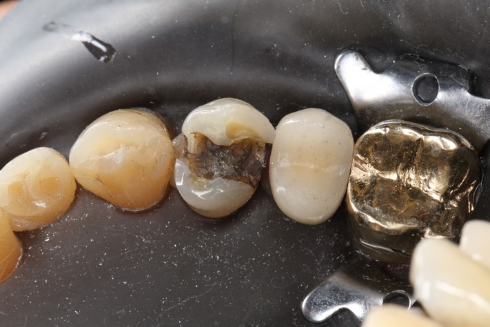 Wes Sato #5 amalgam removal