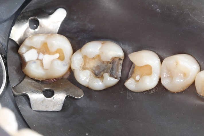 Ted Kanamori #30 amalgam removal