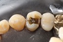 Wes Sato #5 caries removal
