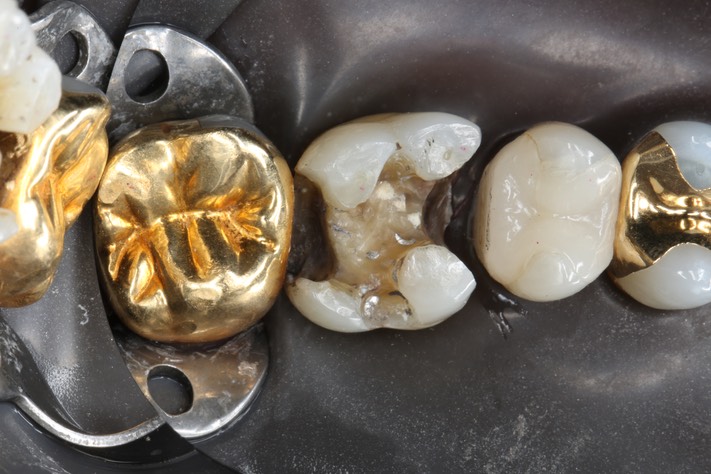 Kyle Chock #14 caries removal