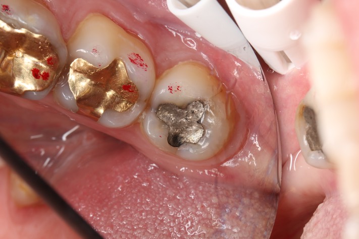 Mark Chun #17 pre-op