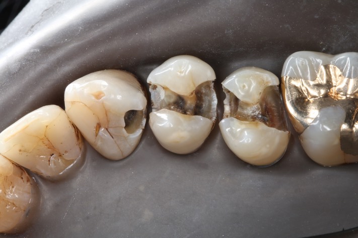 Larry Fujioka #4,5,6 caries removal