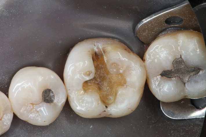 John Wu #19 caries removal