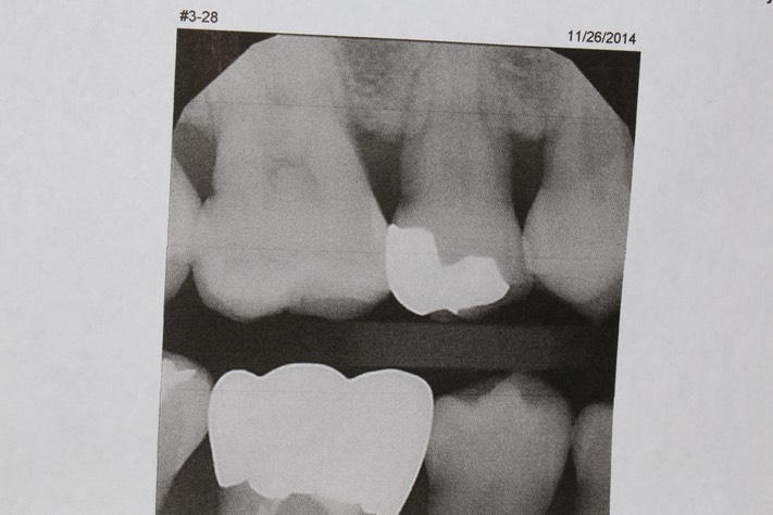 Chris Woo #4 bitewing