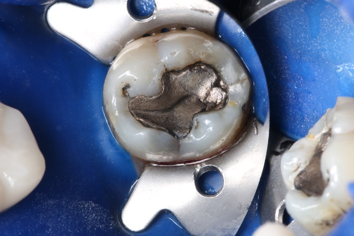 Mark Chun #17 pre-op