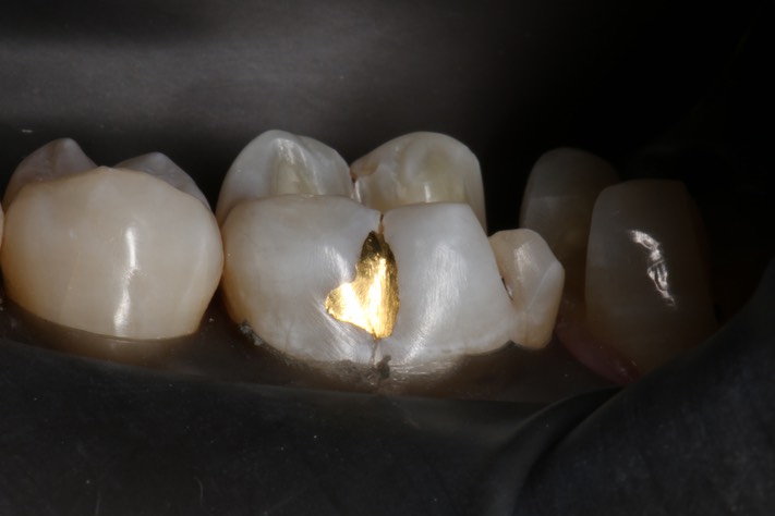 Gary Umeda #19 buccal