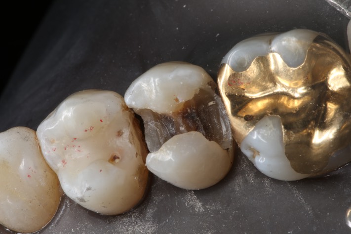 Bryan Sato #4 caries removal