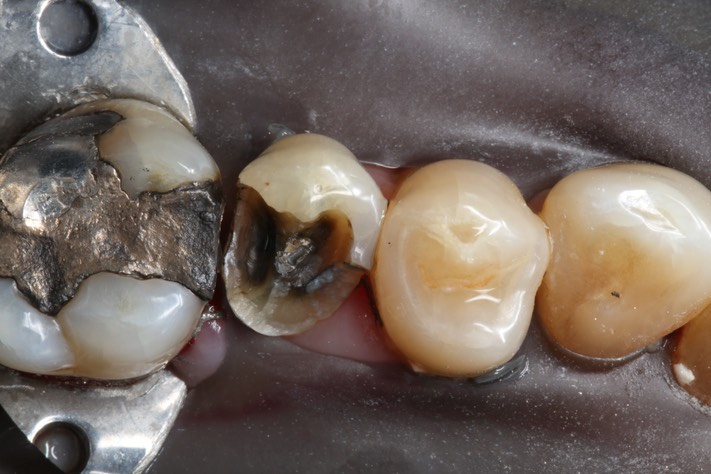 Chris Woo #13 caries removal