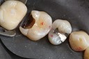Scott Kanamori #14 caries removal