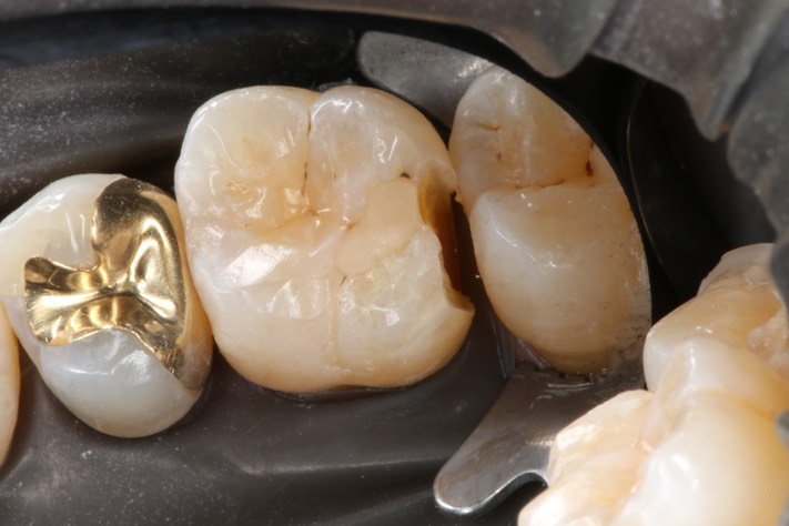 Kyle Chock #3 pre-op