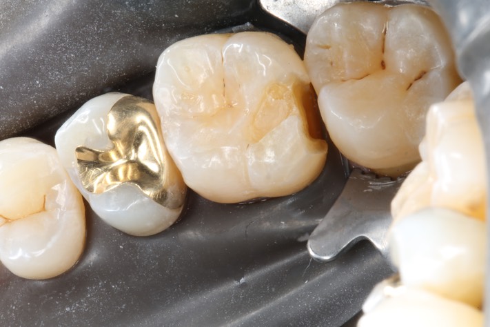 Kyle Chock #3 caries removal