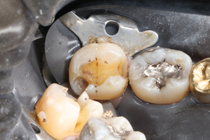 Russ Tabata #31 caries removal