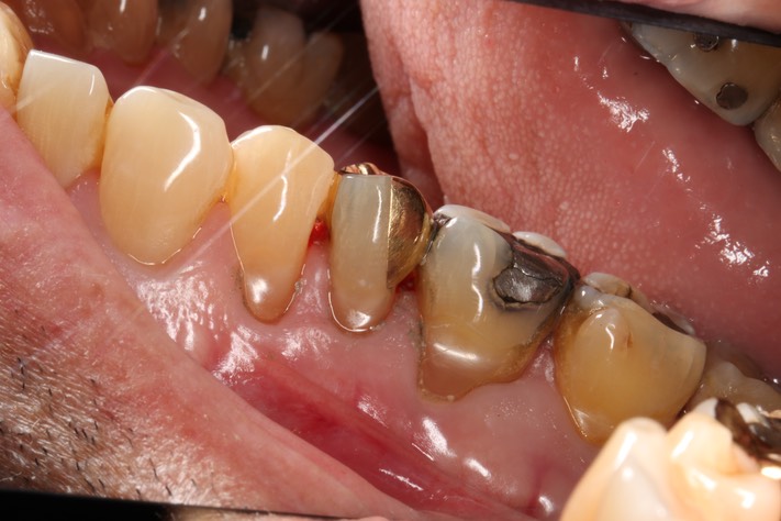 Chris Woo #13 buccal view