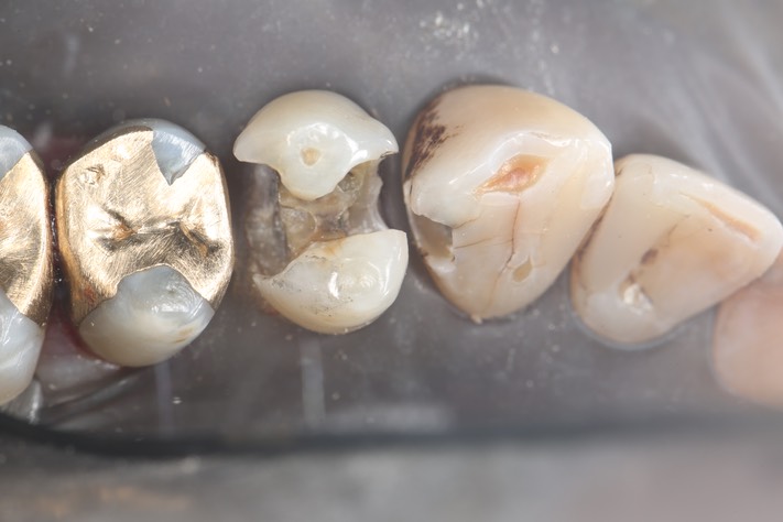 Larry Fujioka #11-12 caries removal