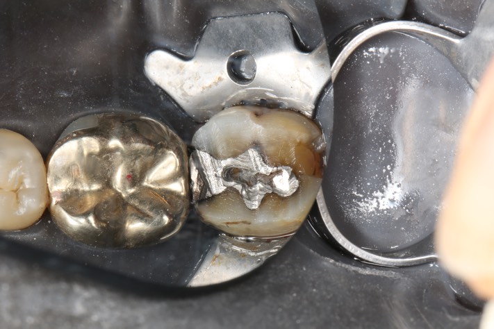 Kyle Chock #18 pre-op