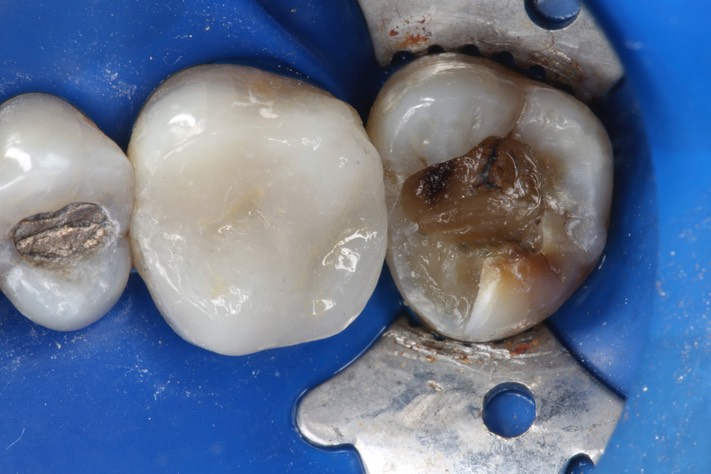 Mark Chun #2 caries removal