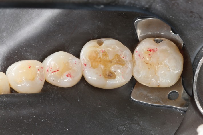 Alan Chinn #19 caries removal