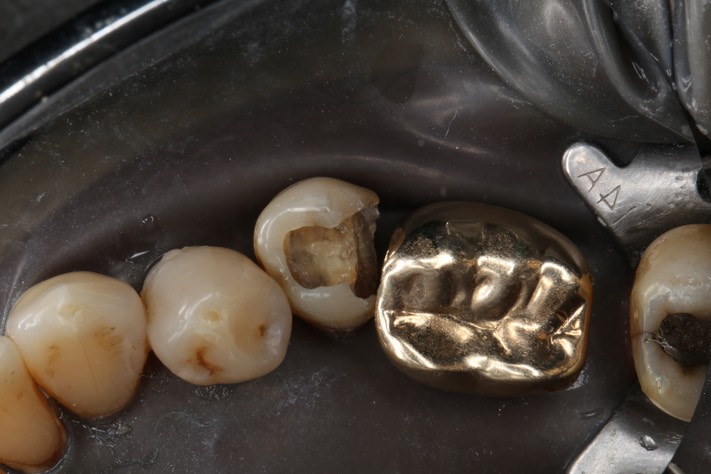 Larry Fujioka #20 amalgam removal